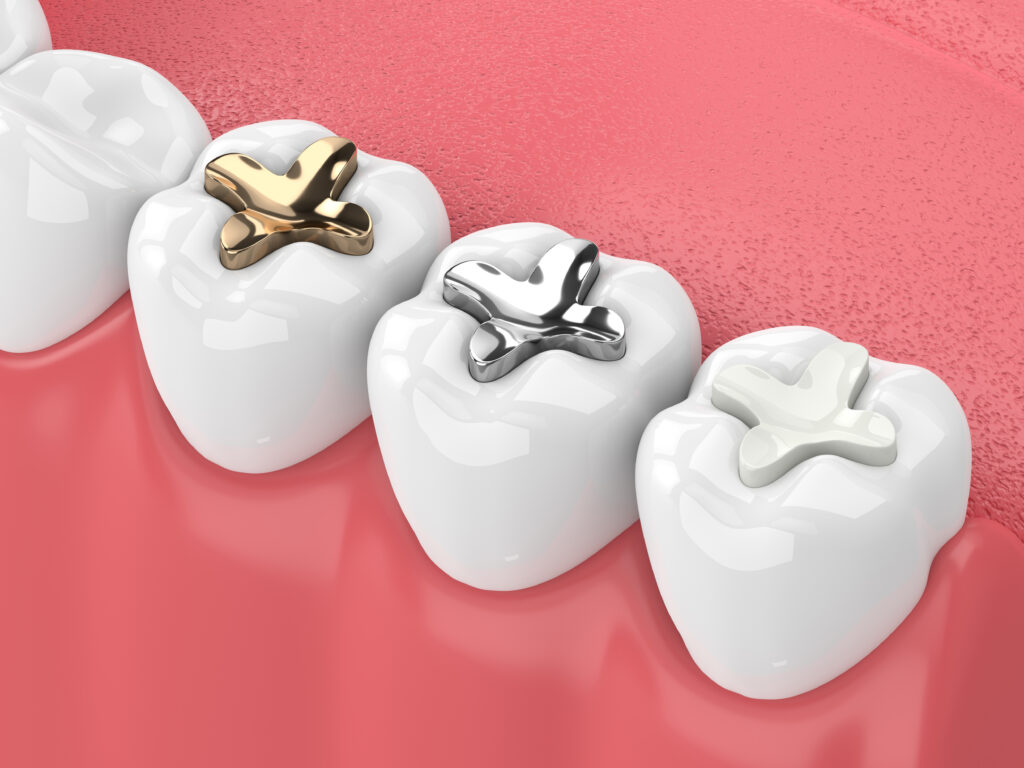 Image-of-dental-inlays-onlays