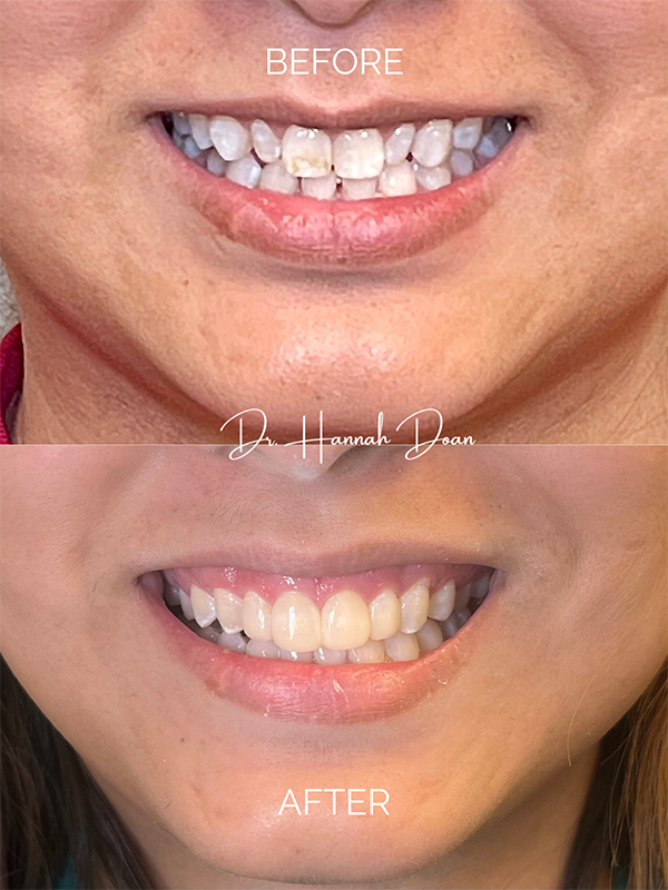 Cosmetic Bonding before and after